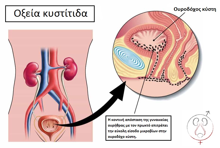 Ουρολοίμωξη